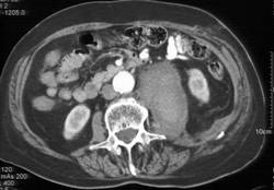 Psoas Bleed - CTisus CT Scan