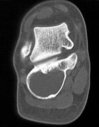 Single Cyst of the Calcaneus - CTisus CT Scan