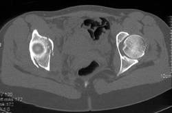 Acetabluar Fracture - CTisus CT Scan