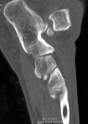 Navicular Fracture - CTisus CT Scan