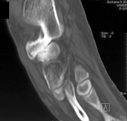 Tarsal Coalition - CTisus CT Scan