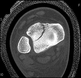 Fracture Through Epiphysis - CTisus CT Scan