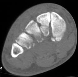 Multiple Fractures- Crush Injury - CTisus CT Scan