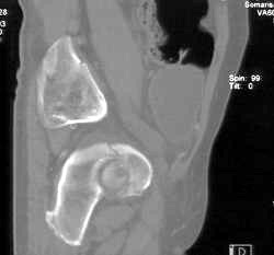 Acetabular Fracture - CTisus CT Scan