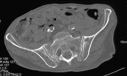 Stress Fracture Sacrum - CTisus CT Scan