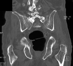 Stress Fracture - CTisus CT Scan