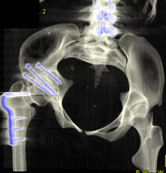 Post Osteotomy in 3D - CTisus CT Scan