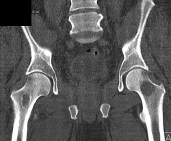 Myeloma - CTisus CT Scan