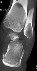 Calcaneal Fracture - CTisus CT Scan