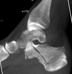 Calcaneal Fracture - CTisus CT Scan