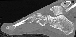 Cystic Changes Calcaneus - CTisus CT Scan