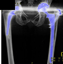 Failed Left Total Hip Replacement - CTisus CT Scan