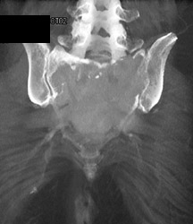 Plasmocytoma - CTisus CT Scan