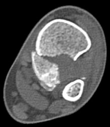 Tibial Fracture - CTisus CT Scan