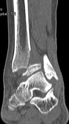 Fracture Extends Through Tibial Epiphysis - CTisus CT Scan