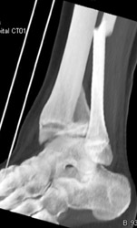 Fracture Along Epiphyseal Plate - CTisus CT Scan