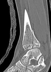 Tibial Fracture - CTisus CT Scan