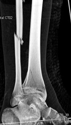 Tibial and Fibular Fracture - CTisus CT Scan