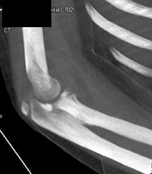 Ulnar Fracture - CTisus CT Scan