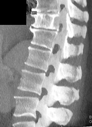 Myeloma - CTisus CT Scan