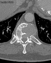 Myeloma - CTisus CT Scan