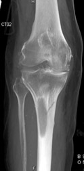 Metastatic Lesion With Pathologic Fracture - CTisus CT Scan