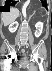 Liposarcoma - CTisus CT Scan