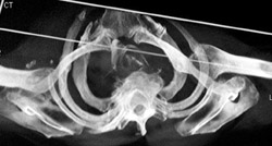 Dysplastic Shoulders With Dislocation - CTisus CT Scan