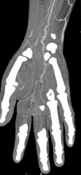 Ct Angiogram of the Hand - CTisus CT Scan