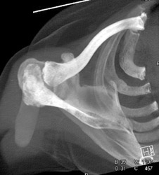 Bone Metastases to the Scapula - CTisus CT Scan