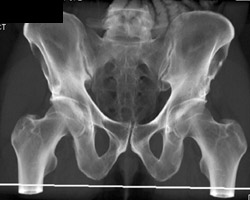 Hemangioma of Iliac Bone - CTisus CT Scan