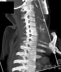 Fusion of C5-6 - CTisus CT Scan