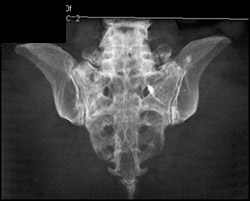 Stress Fracture Sacrum - CTisus CT Scan