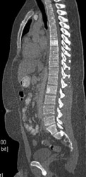 Blastic Bone Metastases - CTisus CT Scan