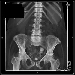 Secondary Hyperparathyroidism - CTisus CT Scan