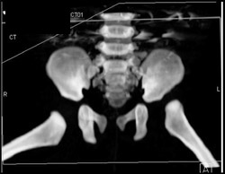 Dislocated Left Femur- Chd - CTisus CT Scan