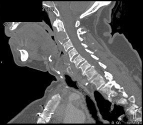 Metastatic Thyroid Cancer to C-spine - CTisus CT Scan