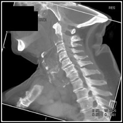 C-spine Metastases to C-2 - CTisus CT Scan