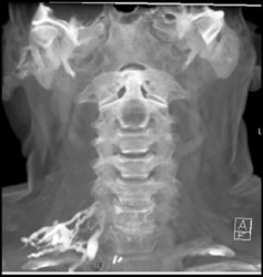 C-spine Metastases From Thyroid Cancer - CTisus CT Scan