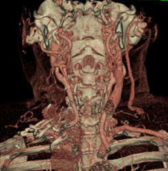 Recurrent Thyroid Cancer - CTisus CT Scan