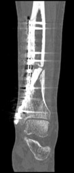 Nonunion Tibia - CTisus CT Scan