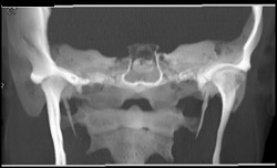 Normal Temporomandibular Joints (TM Joints) - CTisus CT Scan