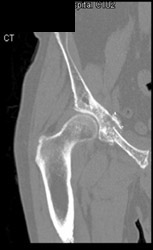 Stress Fractures (sacrum and Pelvis) - CTisus CT Scan