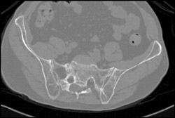 Stress Fracture Sacrum - CTisus CT Scan