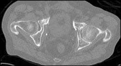 Stress Fracture - CTisus CT Scan