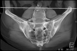 Stress Fracture Sacrum - CTisus CT Scan