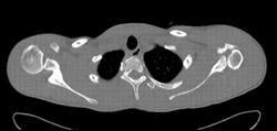 Congenital Shoulder Dislocation - CTisus CT Scan