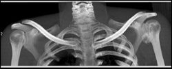 Deformed Humeral Heads - CTisus CT Scan