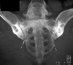 Stress Fracture Sacrum - CTisus CT Scan