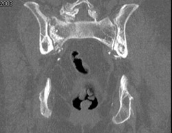 Stress Fracture Sacrum (lt) - CTisus CT Scan